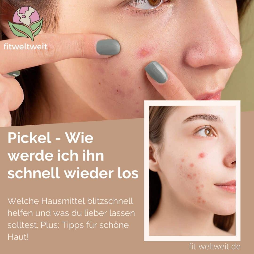 Pickel, wie du ihn schnell wieder los wirst!